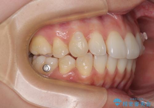 抜歯矯正の軽度後戻りを解消 インビザライン矯正の治療中