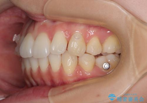 抜歯矯正の軽度後戻りを解消 インビザライン矯正の治療中