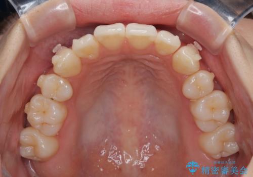 抜歯矯正の軽度後戻りを解消 インビザライン矯正の治療中