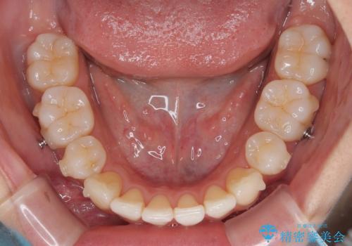 抜歯矯正の軽度後戻りを解消 インビザライン矯正の治療中