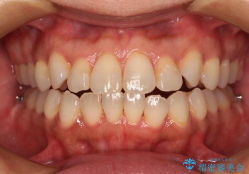 前歯のクロスバイト インビザラインによる矯正治療の治療中
