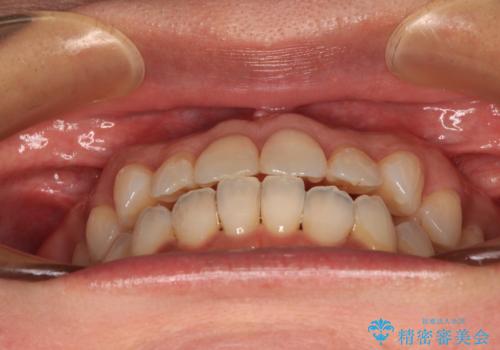 前歯のクロスバイト インビザラインによる矯正治療の治療中
