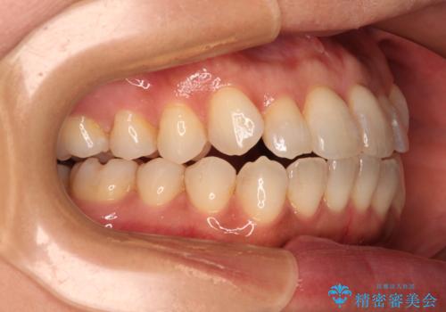 前歯のクロスバイト インビザラインによる矯正治療の治療中