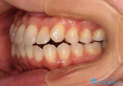 前歯のクロスバイト インビザラインによる矯正治療の治療中