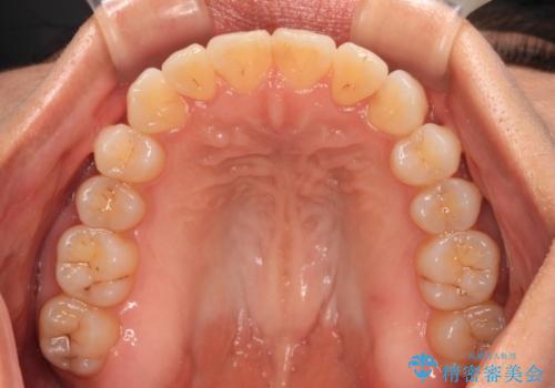 前歯のクロスバイト インビザラインによる矯正治療の治療中