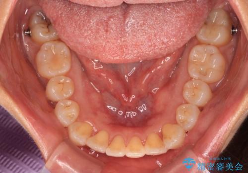 前歯のクロスバイト インビザラインによる矯正治療の治療中