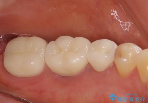 目立つ銀歯をセラミックに 奥歯の審美歯科治療の治療後
