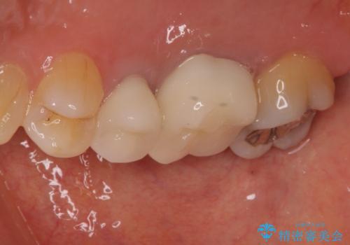 目立つ銀歯をセラミックに 奥歯の審美歯科治療の治療後