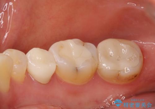 目立つ銀歯をセラミックに 奥歯の審美歯科治療の治療後
