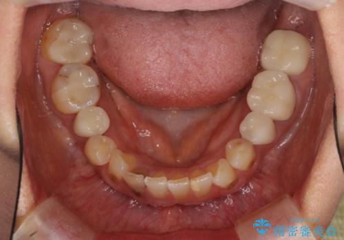 目立つ銀歯をセラミックに 奥歯の審美歯科治療の治療後
