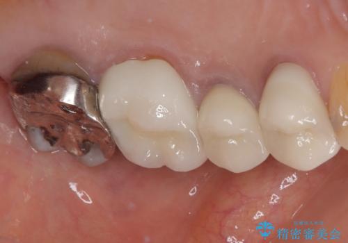 目立つ銀歯をセラミックに 奥歯の審美歯科治療の治療後