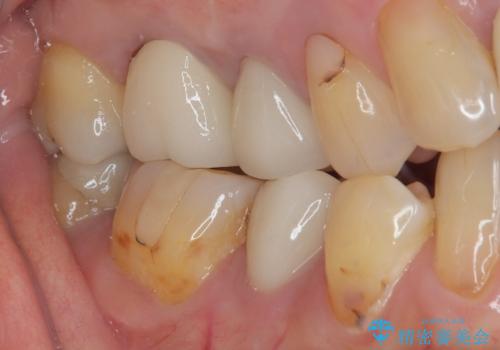 目立つ銀歯をセラミックに 奥歯の審美歯科治療の治療後