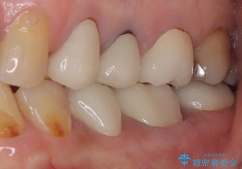 目立つ銀歯をセラミックに 奥歯の審美歯科治療の治療後