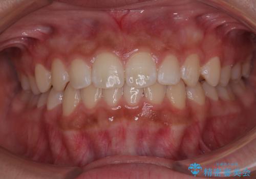 気になるすきっ歯を短期間で改善 インビザライン矯正の症例 治療後