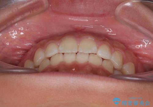 気になるすきっ歯を短期間で改善 インビザライン矯正の治療後