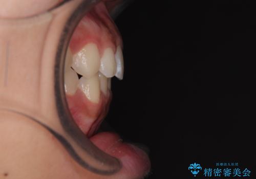 気になるすきっ歯を短期間で改善 インビザライン矯正の治療後