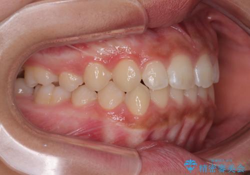 気になるすきっ歯を短期間で改善 インビザライン矯正の治療後