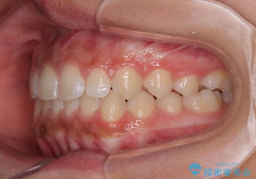 気になるすきっ歯を短期間で改善 インビザライン矯正の治療後