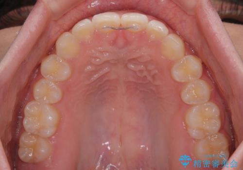 気になるすきっ歯を短期間で改善　インビザライン矯正の治療後