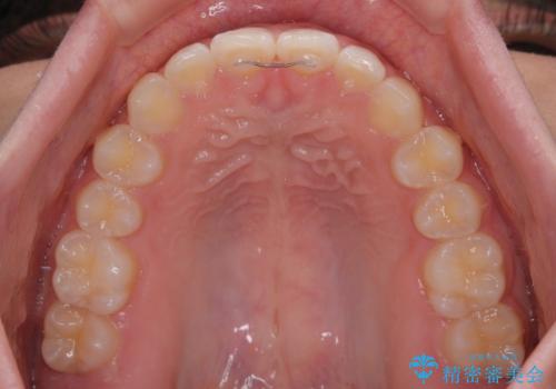 気になるすきっ歯を短期間で改善 インビザライン矯正の治療後