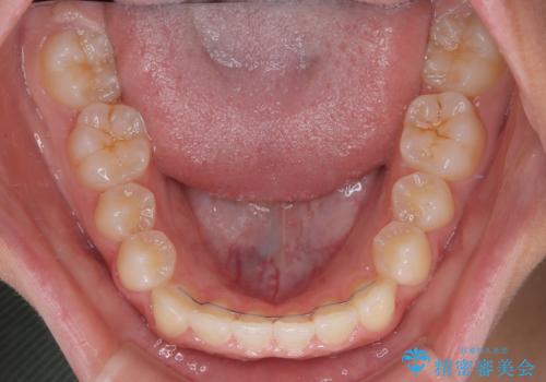 気になるすきっ歯を短期間で改善 インビザライン矯正の治療後