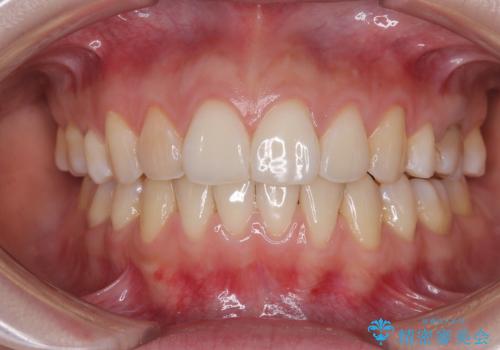 後戻りをインビザラインでスッキリした口元にの症例 治療後