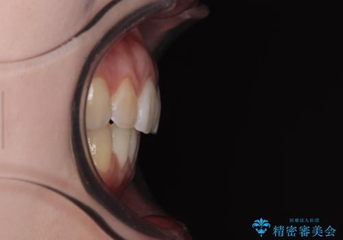 後戻りをインビザラインでスッキリした口元にの治療後