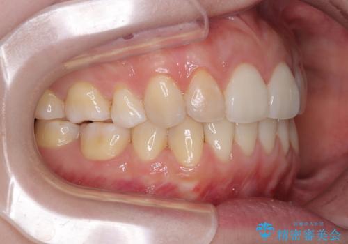 後戻りをインビザラインでスッキリした口元にの治療後