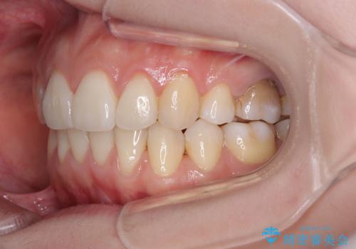 後戻りをインビザラインでスッキリした口元にの治療後