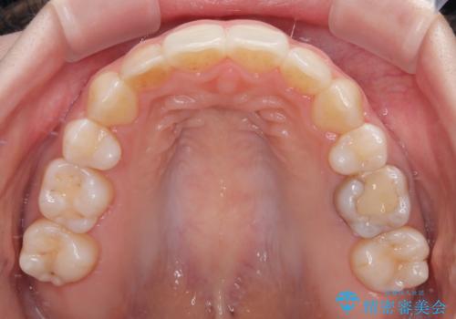 後戻りをインビザラインでスッキリした口元にの治療後