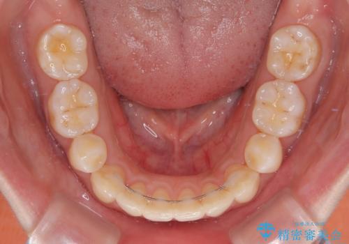 後戻りをインビザラインでスッキリした口元にの治療後