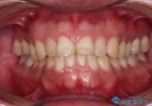 自転車で転んで前歯を損傷 前歯のオールセラミッククラウンの治療前