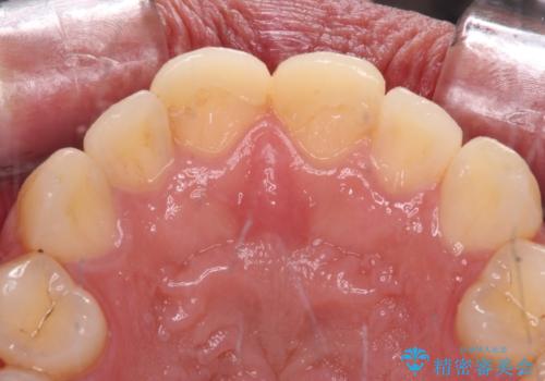 自転車で転んで前歯を損傷 前歯のオールセラミッククラウンの治療前