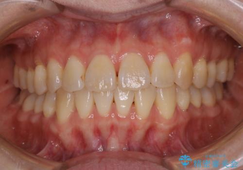 最小限の来院回数で歯並びを改善:インビザライン治療の症例 治療後