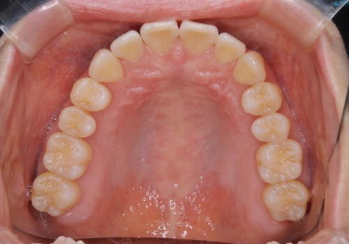 最小限の来院回数で歯並びを改善:インビザライン治療の治療後