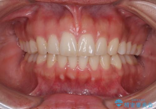 【モニター】突出した前歯 補助装置を併用したインビザライン矯正の治療後