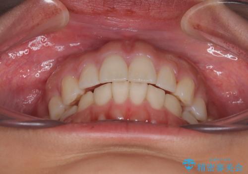 【モニター】突出した前歯 補助装置を併用したインビザライン矯正の治療後