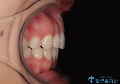 【モニター】突出した前歯 補助装置を併用したインビザライン矯正の治療後