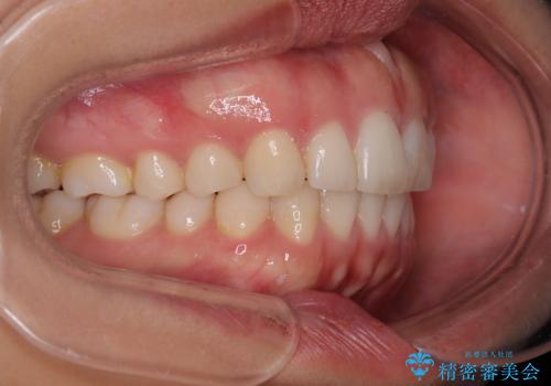 【モニター】突出した前歯 補助装置を併用したインビザライン矯正の治療後