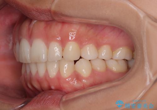 【モニター】突出した前歯 補助装置を併用したインビザライン矯正の治療後