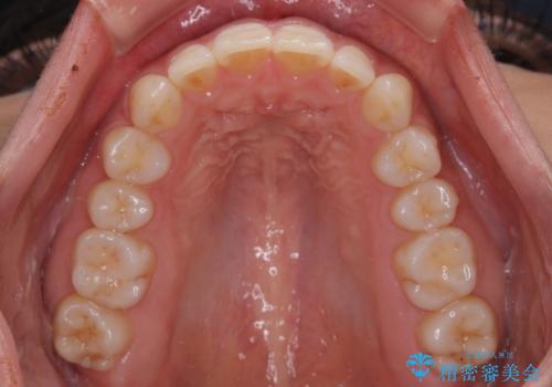 【モニター】突出した前歯 補助装置を併用したインビザライン矯正の治療後