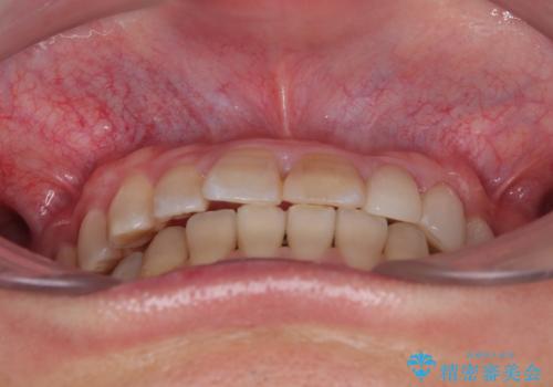 全体的なデコボコが気になる。拡大装置を併用したワイヤー矯正の治療後