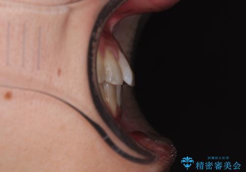 全体的なデコボコが気になる。拡大装置を併用したワイヤー矯正の治療後