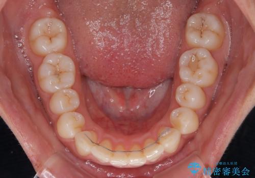 【モニター】突出した前歯 補助装置を併用したインビザライン矯正の治療後