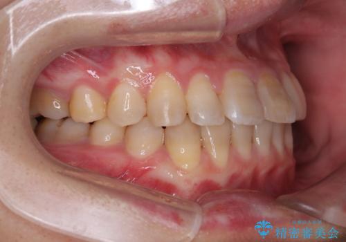 全体的なデコボコが気になる。拡大装置を併用したワイヤー矯正の治療後