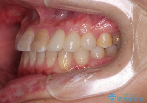 全体的なデコボコが気になる。拡大装置を併用したワイヤー矯正の治療後