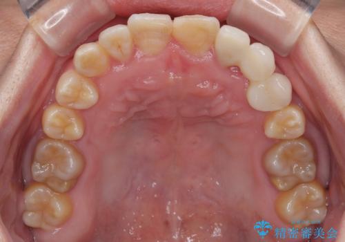 全体的なデコボコが気になる。拡大装置を併用したワイヤー矯正の治療後