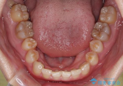 全体的なデコボコが気になる。拡大装置を併用したワイヤー矯正の治療後