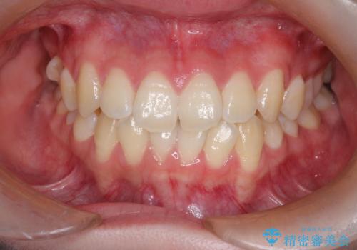 右上小臼歯の捻転を改善|インビザラインと部分ワイヤー矯正のコンビネーション治療の治療前