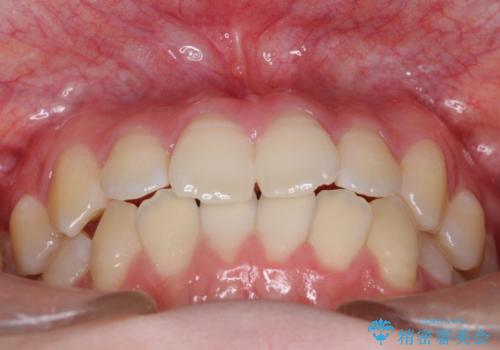 右上小臼歯の捻転を改善|インビザラインと部分ワイヤー矯正のコンビネーション治療の治療前